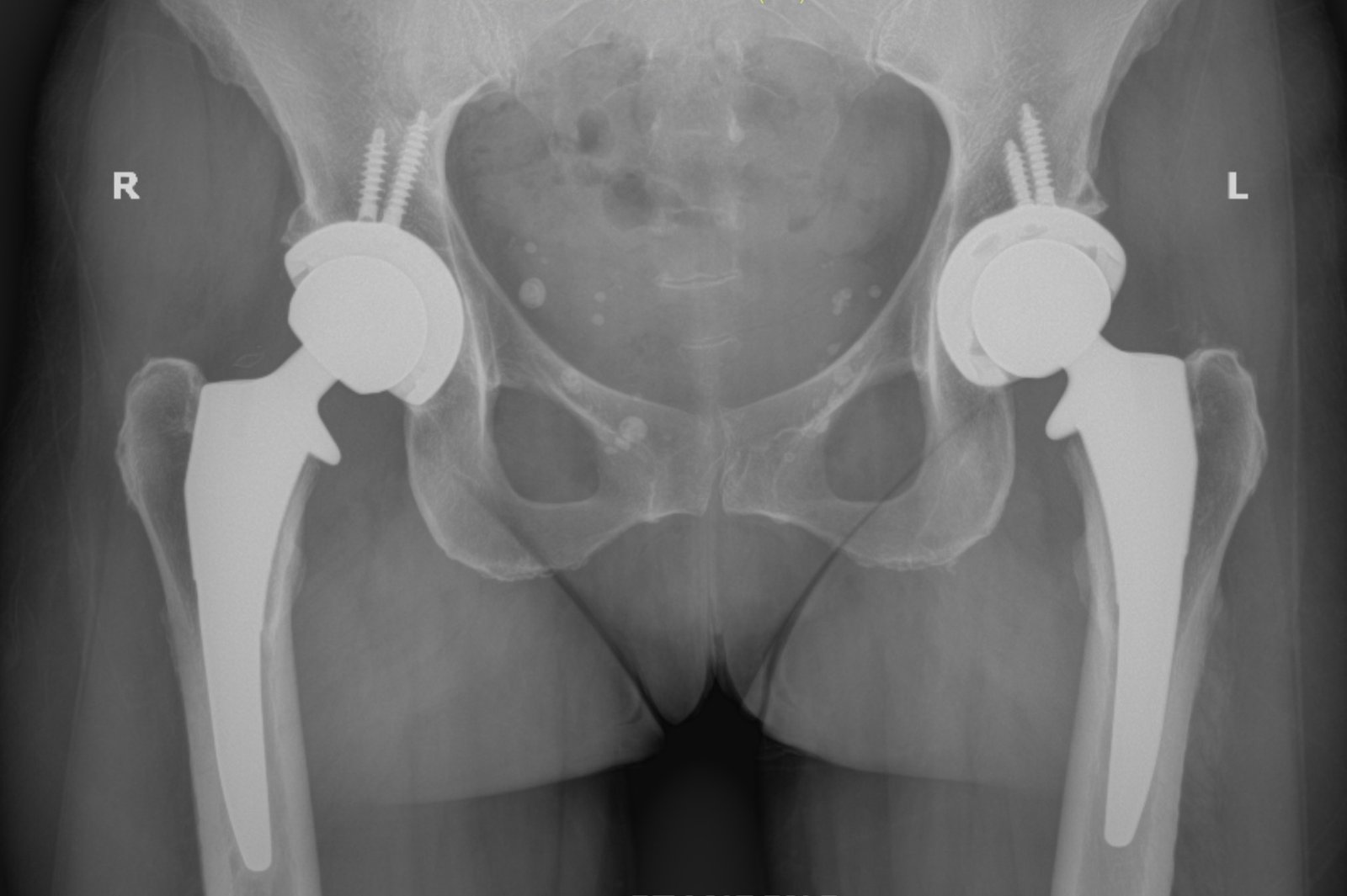 Bilateral total hip replacement X-ray