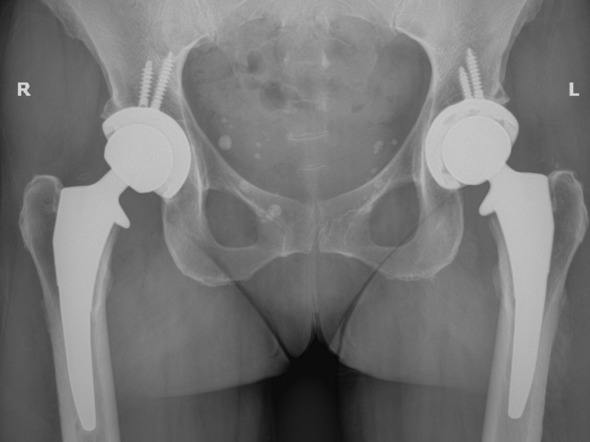 Postoperative X-ray of a total hip replacement, anteroposterior view
