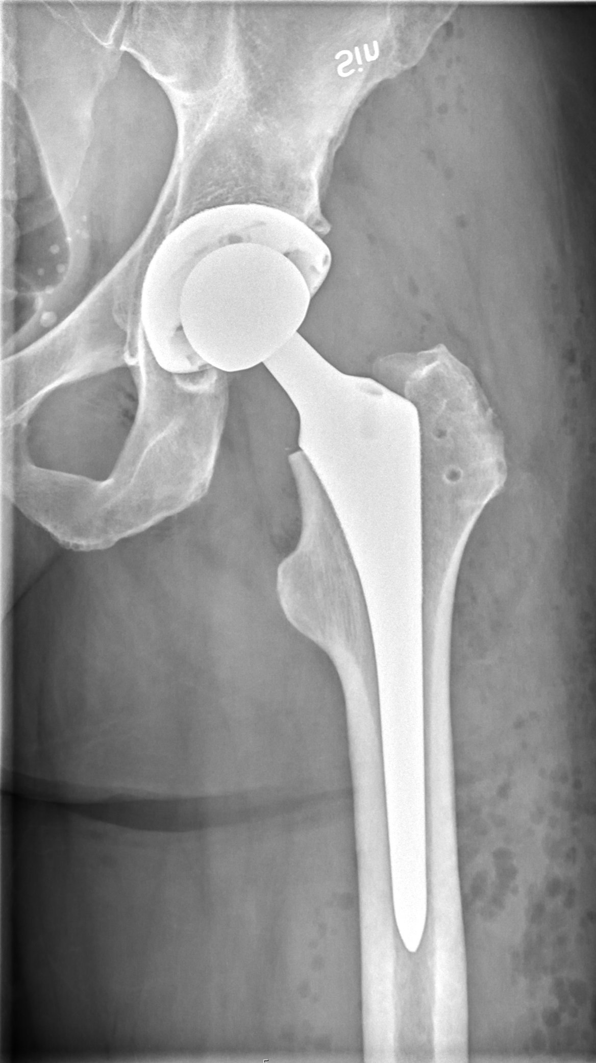 Postoperative X-ray of a total hip replacement, anteroposterior view
