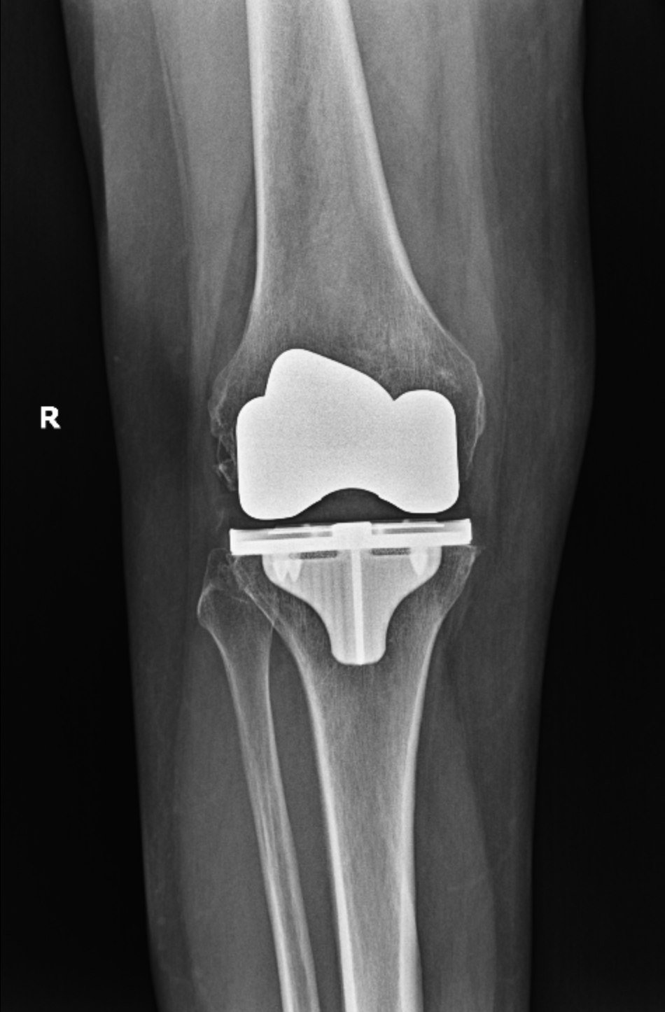 Postoperative X-ray of a total knee replacement, anteroposterior view