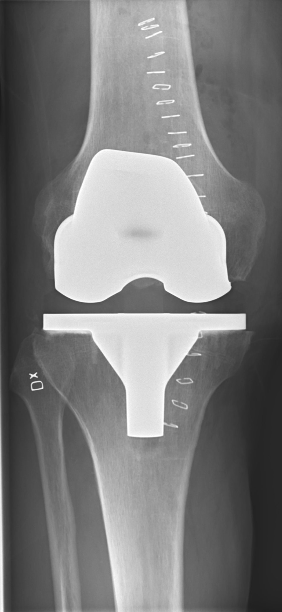 Postoperative X-ray of a total knee replacement, anteroposterior view
